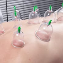 Close-up of cupping therapy being performed, showing silicone cups on skin